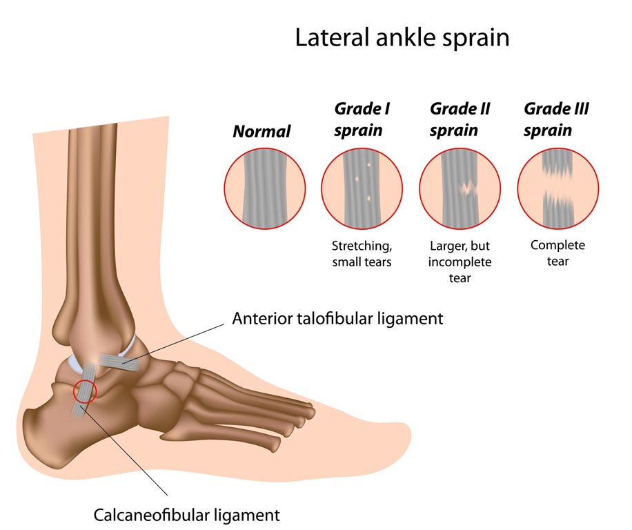 https://www.bestphysicaltherapistnyc.com/wp-content/uploads/2012/09/Best-Physical-Therapist-in-NYC-for-ankle-sprains-02.jpg