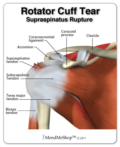 The Rotator Cuff Tear (RTC) — Champion Performance & Physical Therapy
