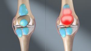 https://www.bestphysicaltherapistnyc.com/wp-content/uploads/2021/07/shoulder-knee-hip-Bursitis-pt-NYC-02-300x169.jpeg